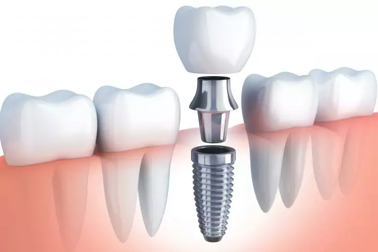 Dental Implants In Fort Walton Beach, Fl