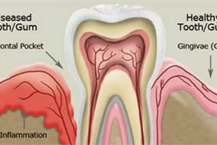 Pregnancy Gingivitis - Aspen Dental of Cache Valley