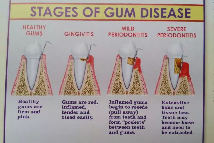 Stages of Gum Disease