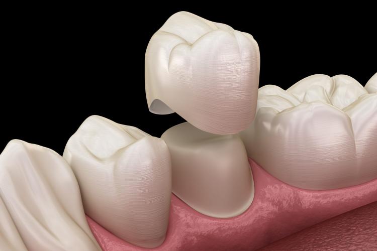 How a General Dentist Uses Crowns to Repair Teeth