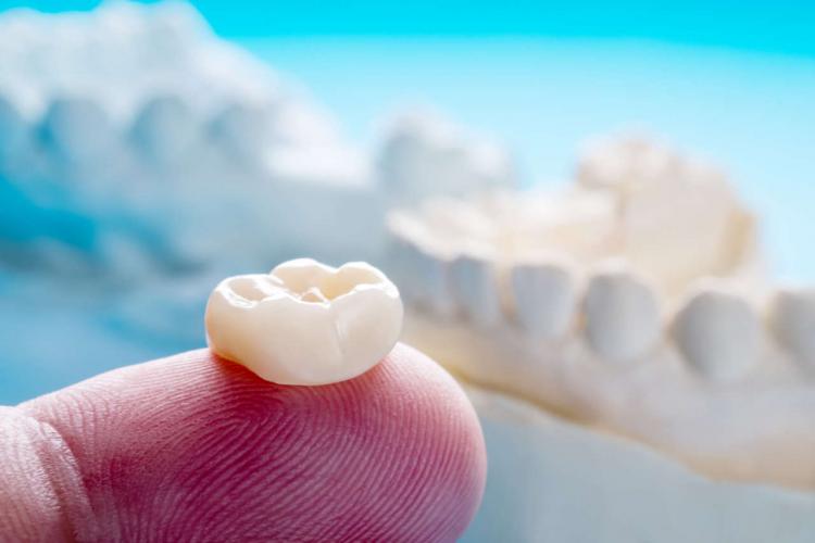 Do Dental Crowns Last Forever?