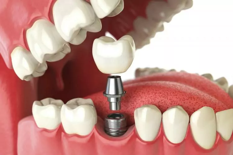 Dental Implants vs Crowns