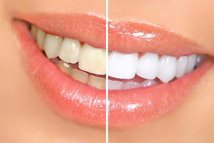 Can Dental Implants be Lightened?