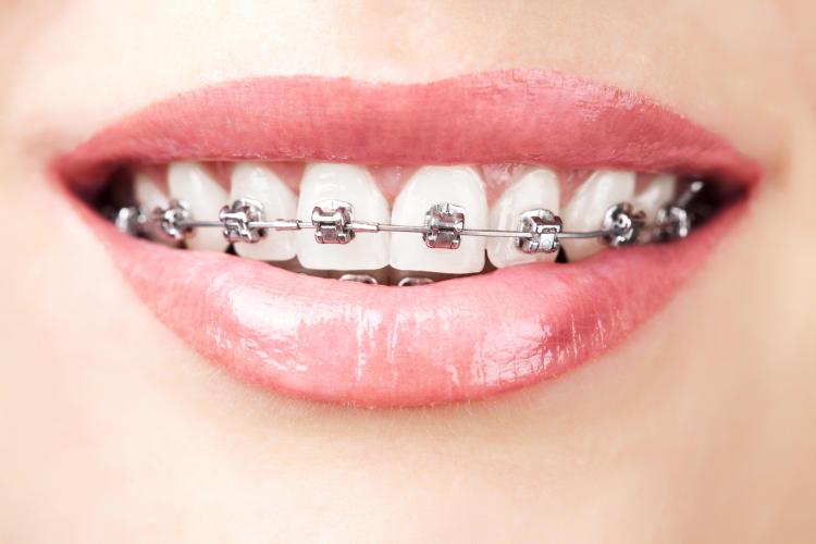 Can Braces Fix an Overbite?