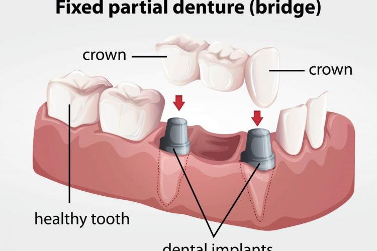 Dental Implants vs Bridges