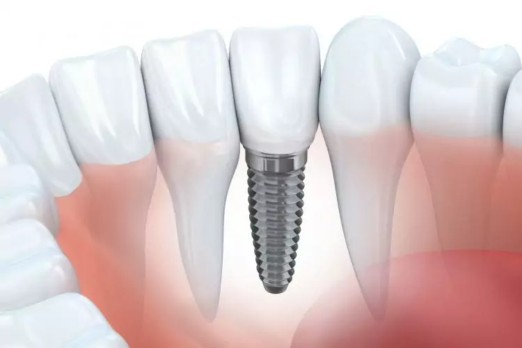 Are Dental Implants Permanent?