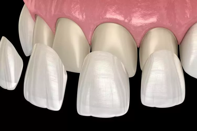 Dental Implants vs Veneers