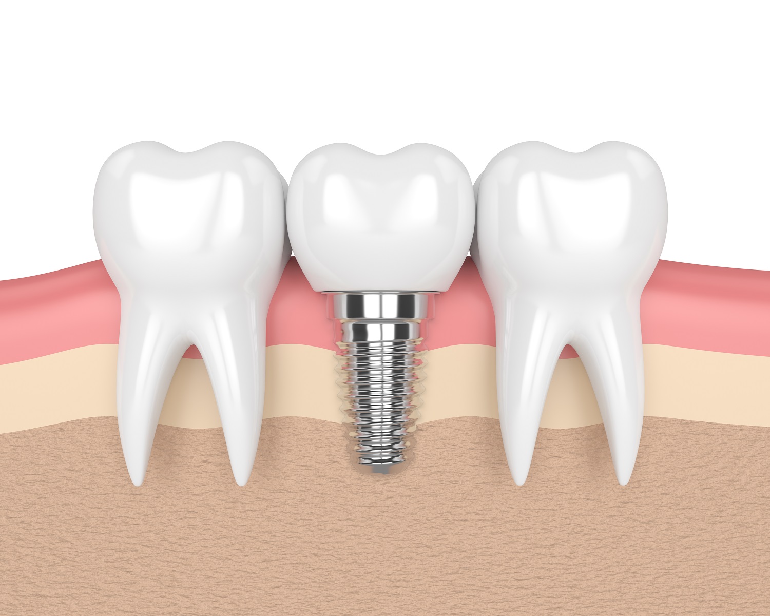 Dental Implant Popularity Family and Cosmetic Dentistry Aspen