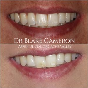 A comparative image illustrating a patient's smile before and after orthodontic treatment and veneers, emphasizing the improvement.