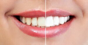 Teeth Whitening Logan UT - Aspen Dental of Cache Valley