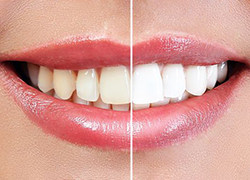 Teeth Whitening Logan UT - Aspen Dental of Cache Valley