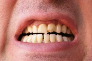 A man showing visibly chipped and cracked teeth.