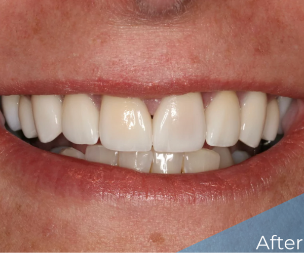 real Patient After photo showing close up of smile transformation