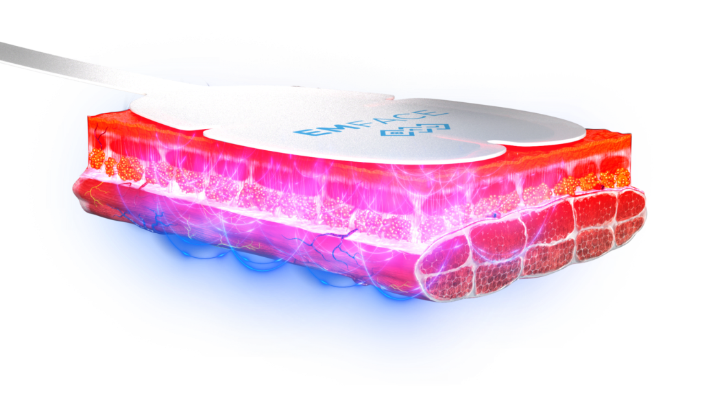 EMFACE treats skin and muscle simultaneously using RF and HIFES energy