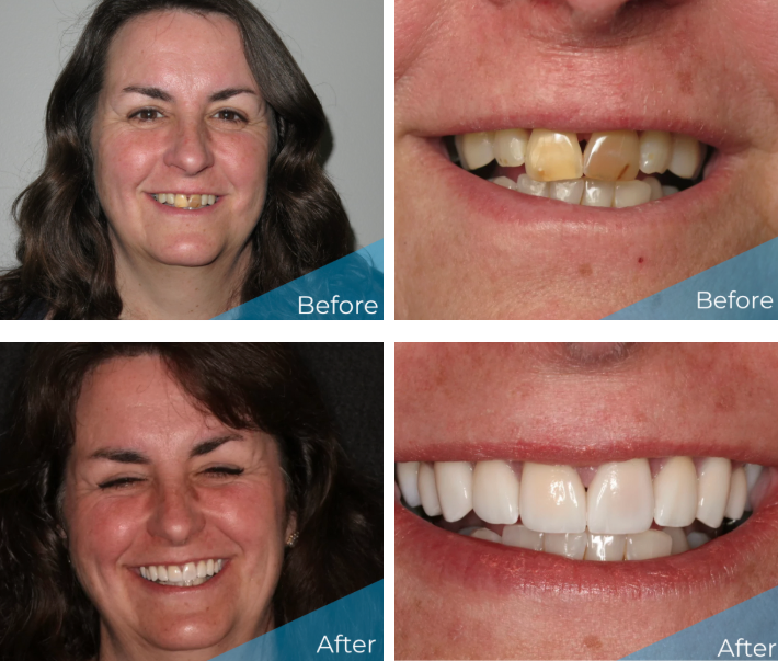 Real patient full mouth reconstruction before and after photos in Cache Valley