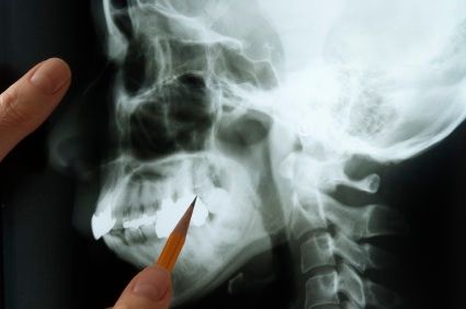 A jawbone being examined by a Logan area dentist.