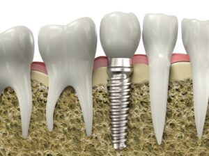 A graphic image of a dental implant placed in a jawbone in Logan.