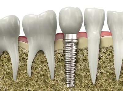 A graphic image of a dental implant placed in a jawbone in Logan.